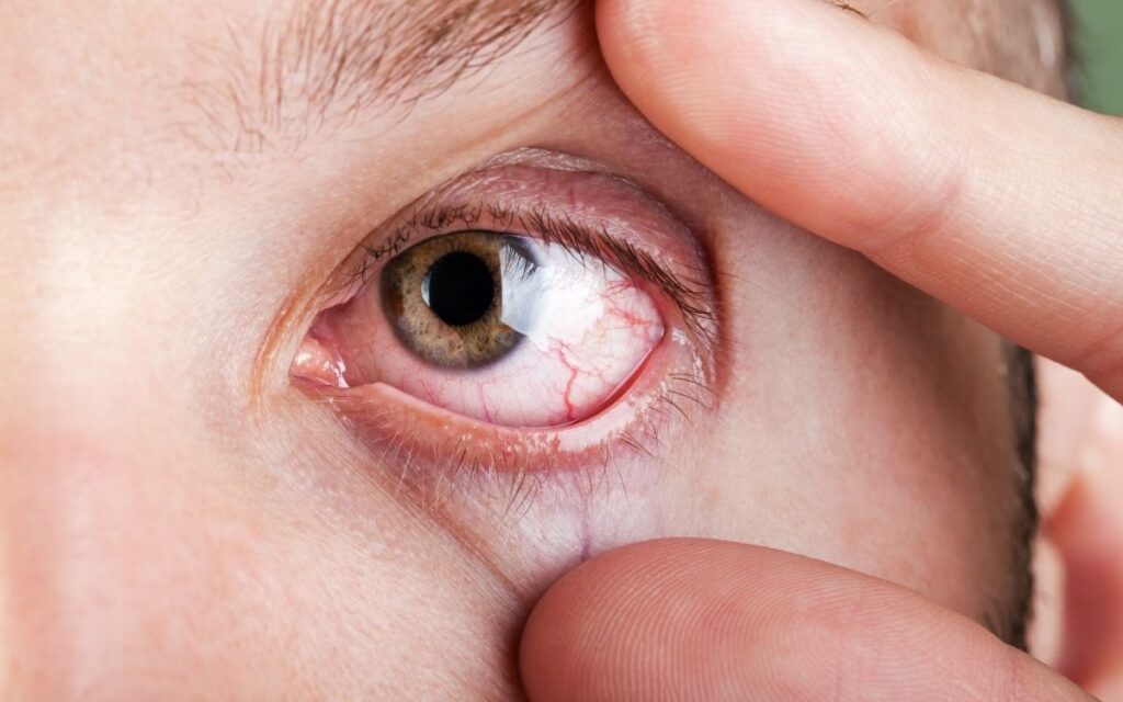 Tratamiento para el ojo seco